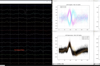 RT-Treat: Real-time neuronal analysis for epilepsy treatment project cover